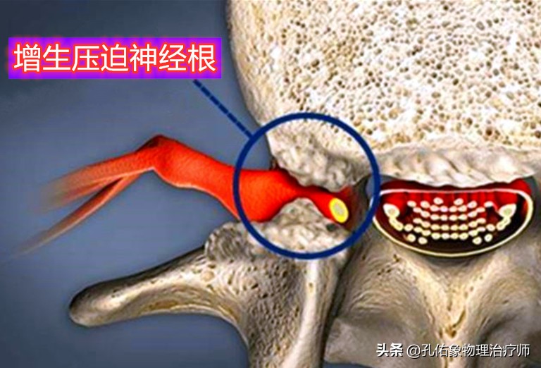 患了颈椎病，会有哪些症状？该如何治疗？