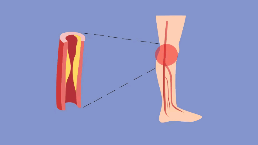 老年人下肢疼痛,无力,常见4个原因,该如何判断?详细告诉您