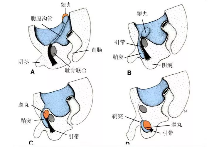 疝气是怎么来的呢?