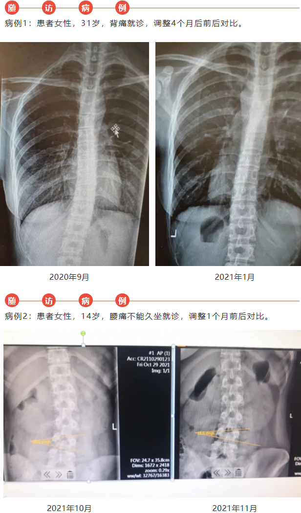 挺直脊梁——中医手法调治特发性脊柱侧弯