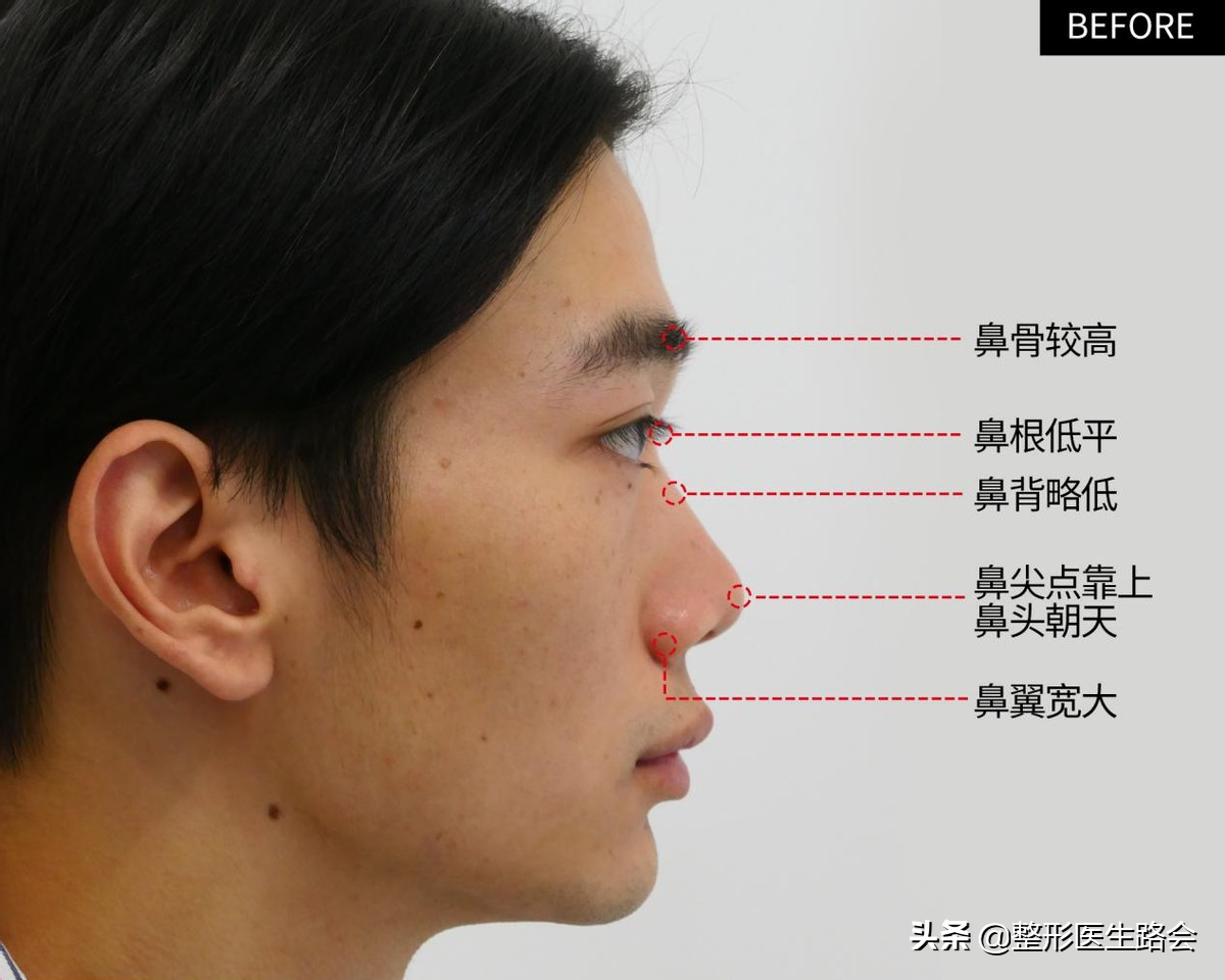 等待2年之久，从海南到北京，鼻整形真实记录，82天后“很惊艳”