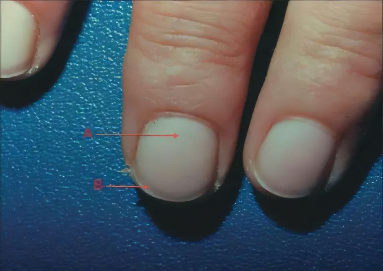 医生告诉你指甲与健康的真相