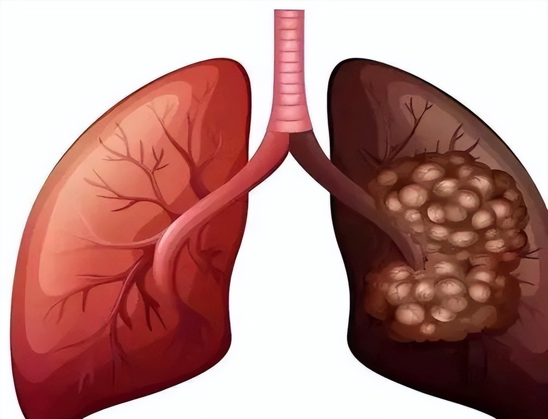 反复出现4个症状,肺部或已发生"病变",需及时检查