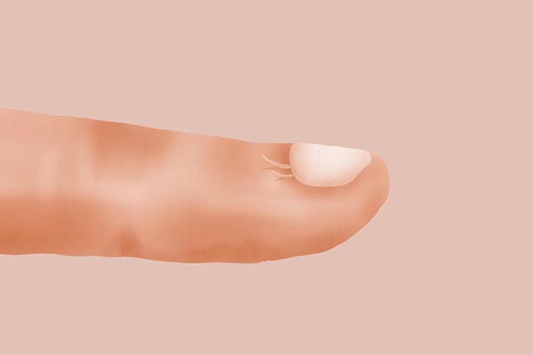 识别指甲的“求救信号”，4种异常表现的指甲，要及时排除癌变