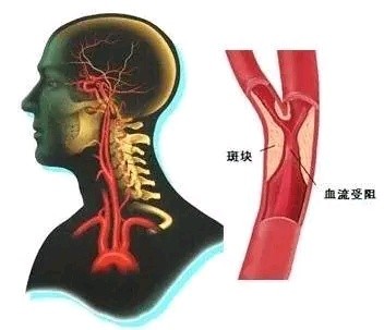 颈动脉斑块，怎么查？怎么治？别吃哪种水果？本文为您全讲清