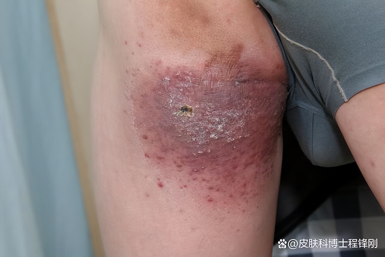 大腿内侧一小块“红斑”，被误诊10年，斑块越治越大
