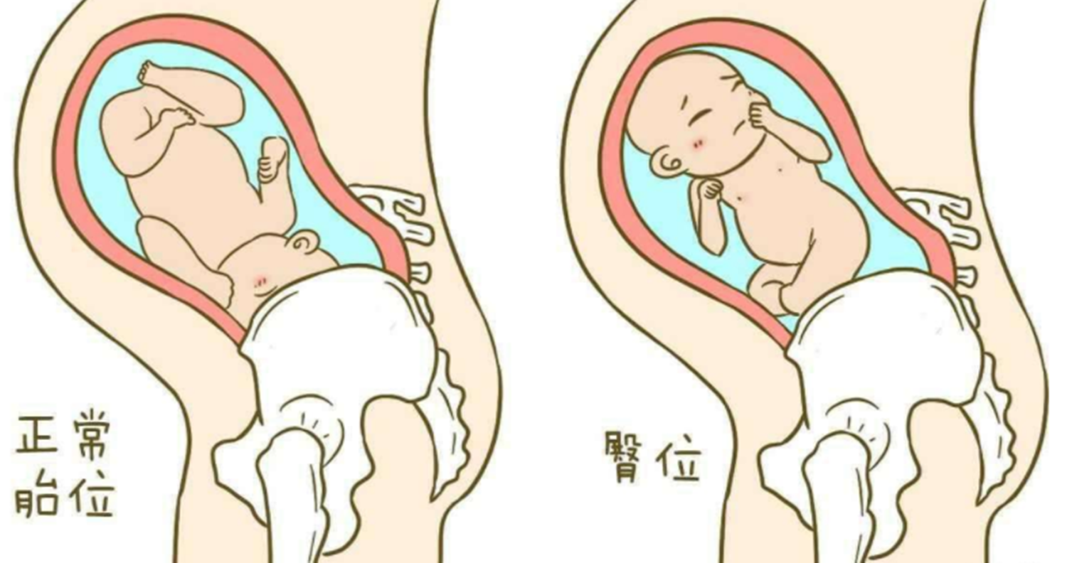 胎儿头位仰卧位图片图片