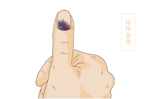 识别指甲的“求救信号”，4种异常表现的指甲，要及时排除癌变