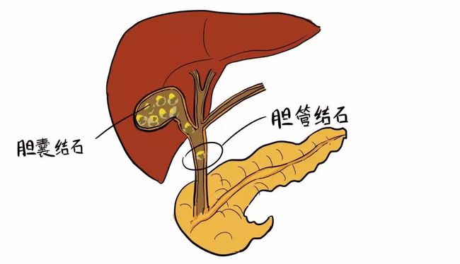 4種用於膽結石,膽囊炎,口苦的中成藥,建議收藏