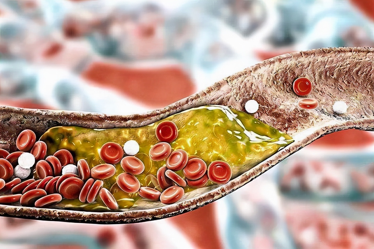 胆固醇高不是小事,坚持4个好习惯,轻松降低胆固醇