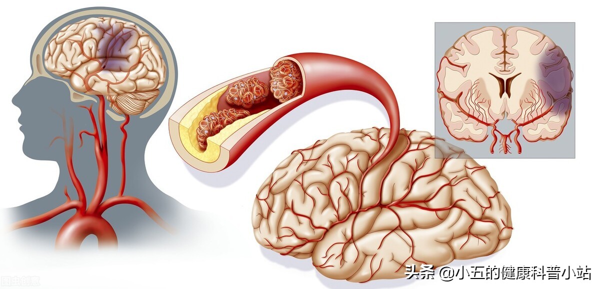 丁苯酞膠囊是治療急性腦梗死常用藥物,到底需要吃多久?一文告知