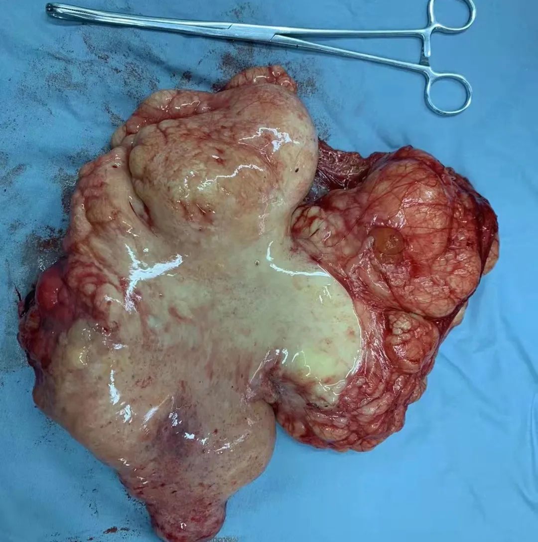 花季少女腹藏巨大肿瘤！省人民医院精心“拆弹”解难题