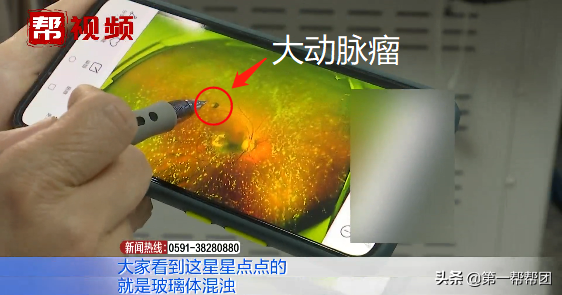 一个月内视力骤降、视物变形？医生在阿婆眼底发现“罪魁祸首”