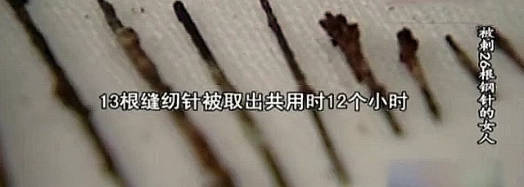 2004年，农妇体内发现藏26根缝衣针，头部钢针直插大脑，凶手成谜