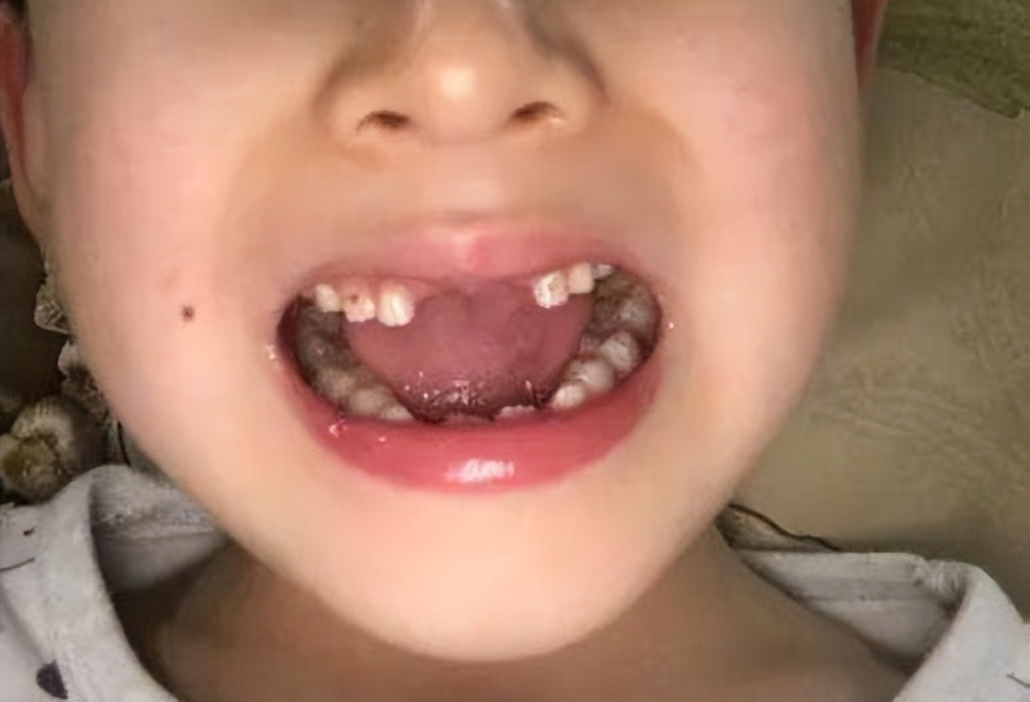 12岁,第二双尖牙;11岁,单尖牙;10岁,第一双尖牙;8-9岁,侧切牙;6-7岁