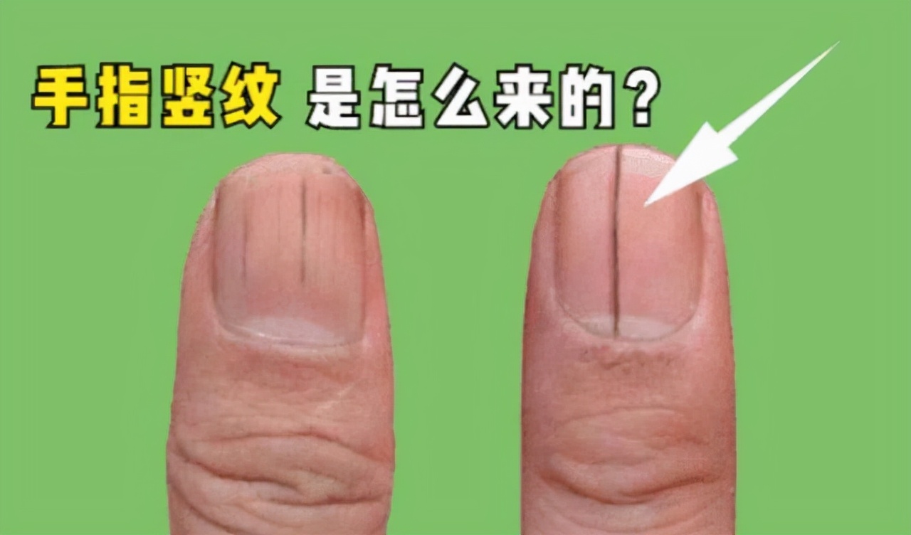 指甲上的月牙,白点,竖纹代表什么?医生告诉你指甲与健康的真相