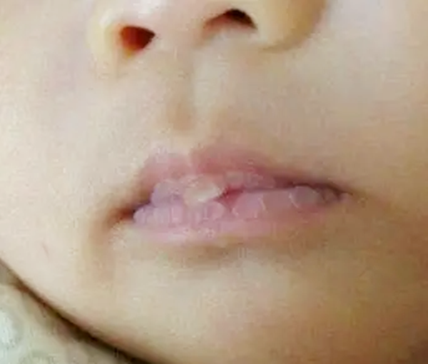 婴儿嘴唇发白图片