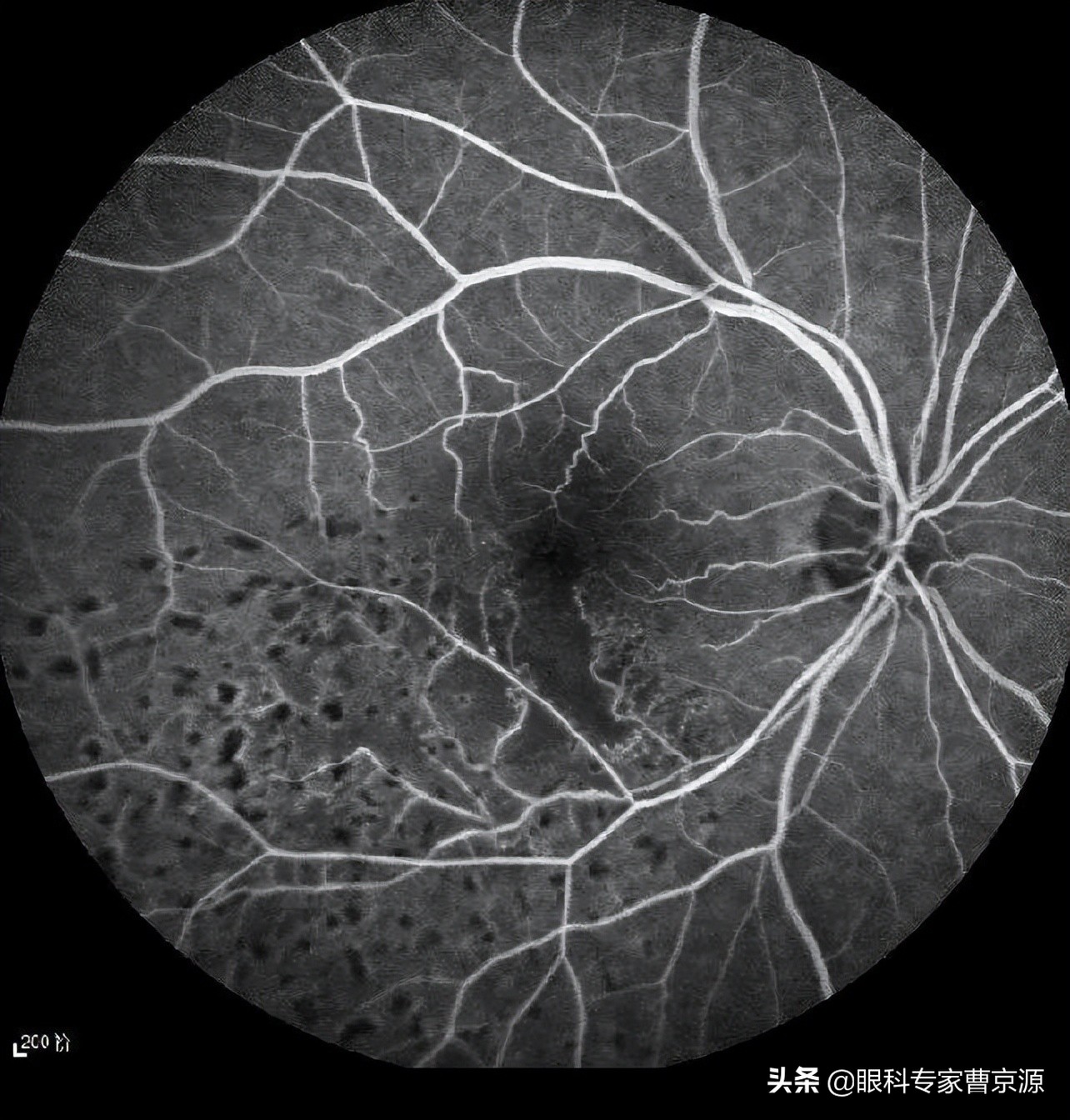 我们可以通过检眼镜来看大概的血管的一个形态.