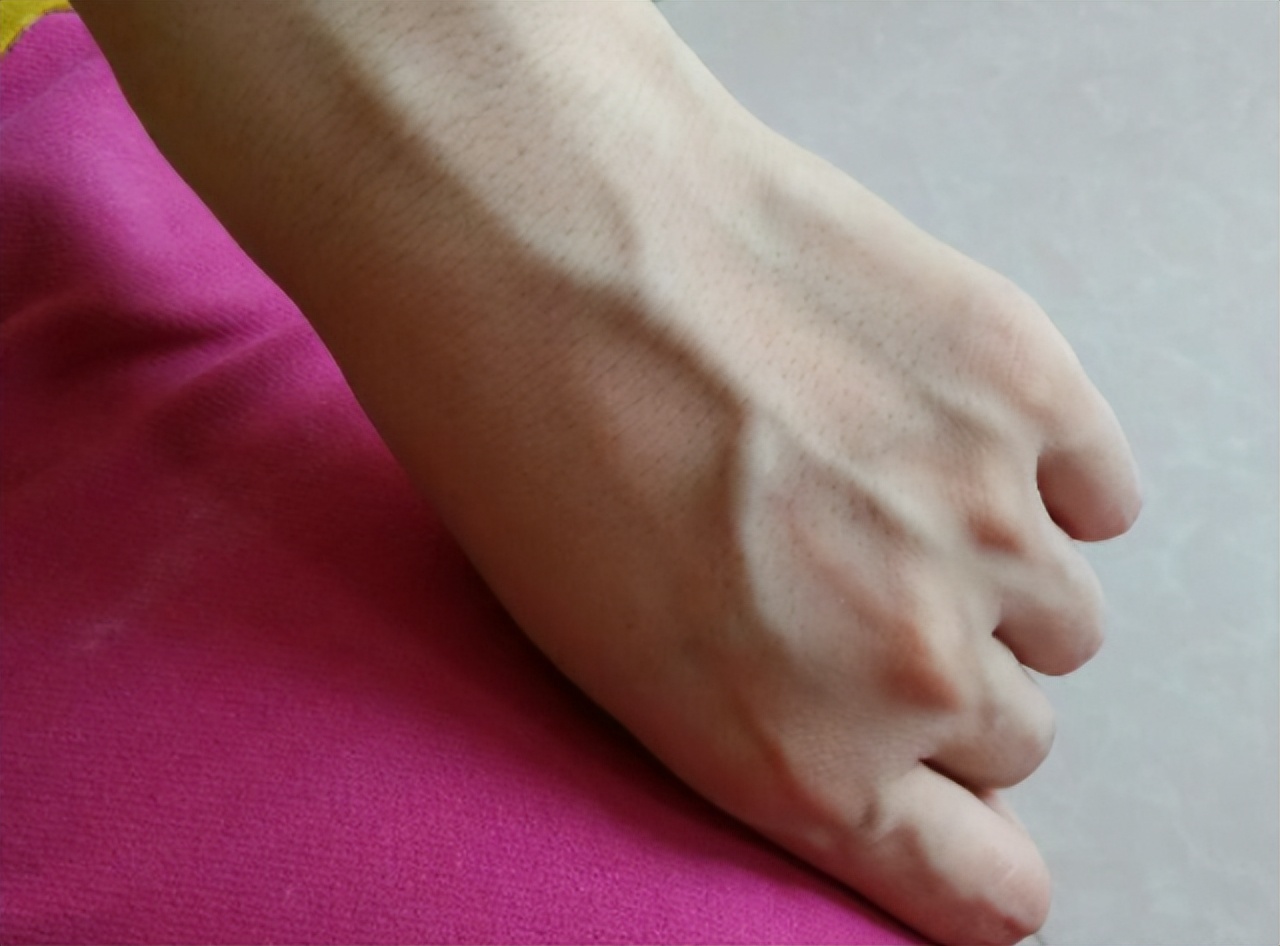 暴起的表现,而身材肥胖的人由于皮下脂肪层较厚,血管被很好地隐藏起来