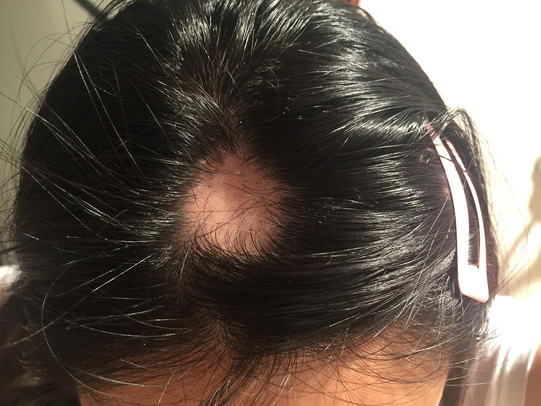 戴帽子会导致脱发秃顶？脱发这件事男性激素很关键，如何预防？