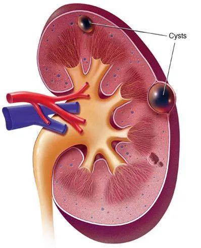 体检查出这19种疾病，医生：其实根本不用治！别再花冤枉钱