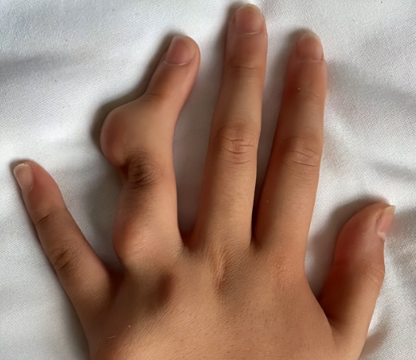 婴儿手腕有骨头突出(手突然剧痛无法动弹) - 乐宝宝贝