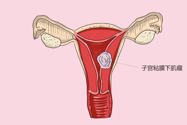 从不做体检！雅安一女子体内取出“拳头大”的子宫肌瘤
