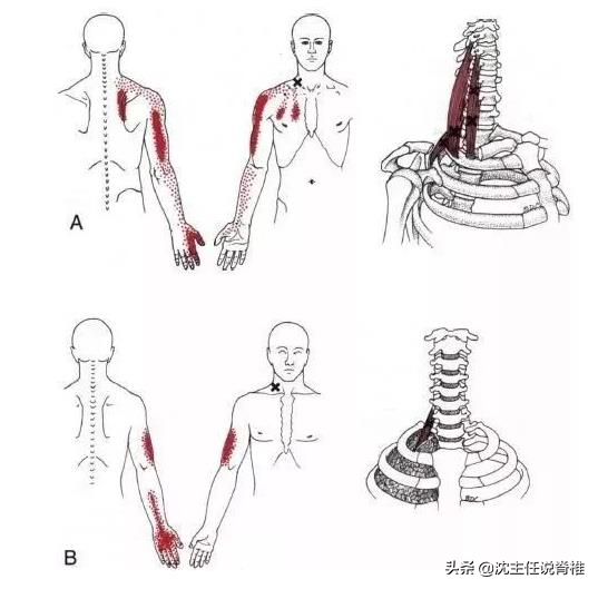 后背、肩胛骨内侧缘疼痛，排除了内科疾病，还要注意这个原因