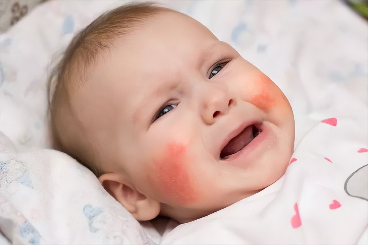 宝宝长口水疹让人心疼，记住这几点，帮助宝宝拥有天使面孔