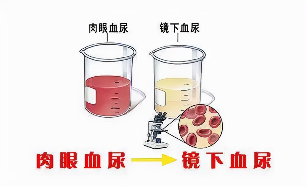 尿的颜色，能看出你得啥病？