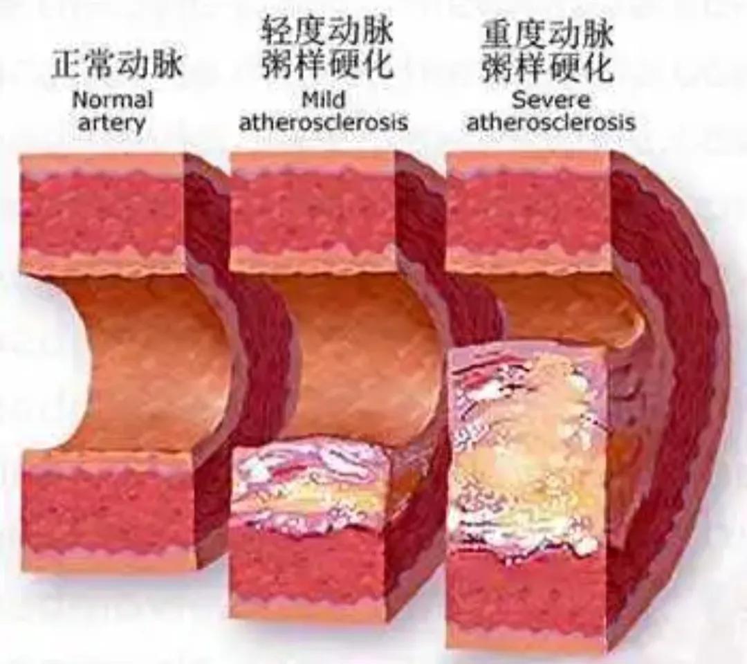 红酒、鱼油会软化血管？保护血管要做好以下3点，血管健康更长寿