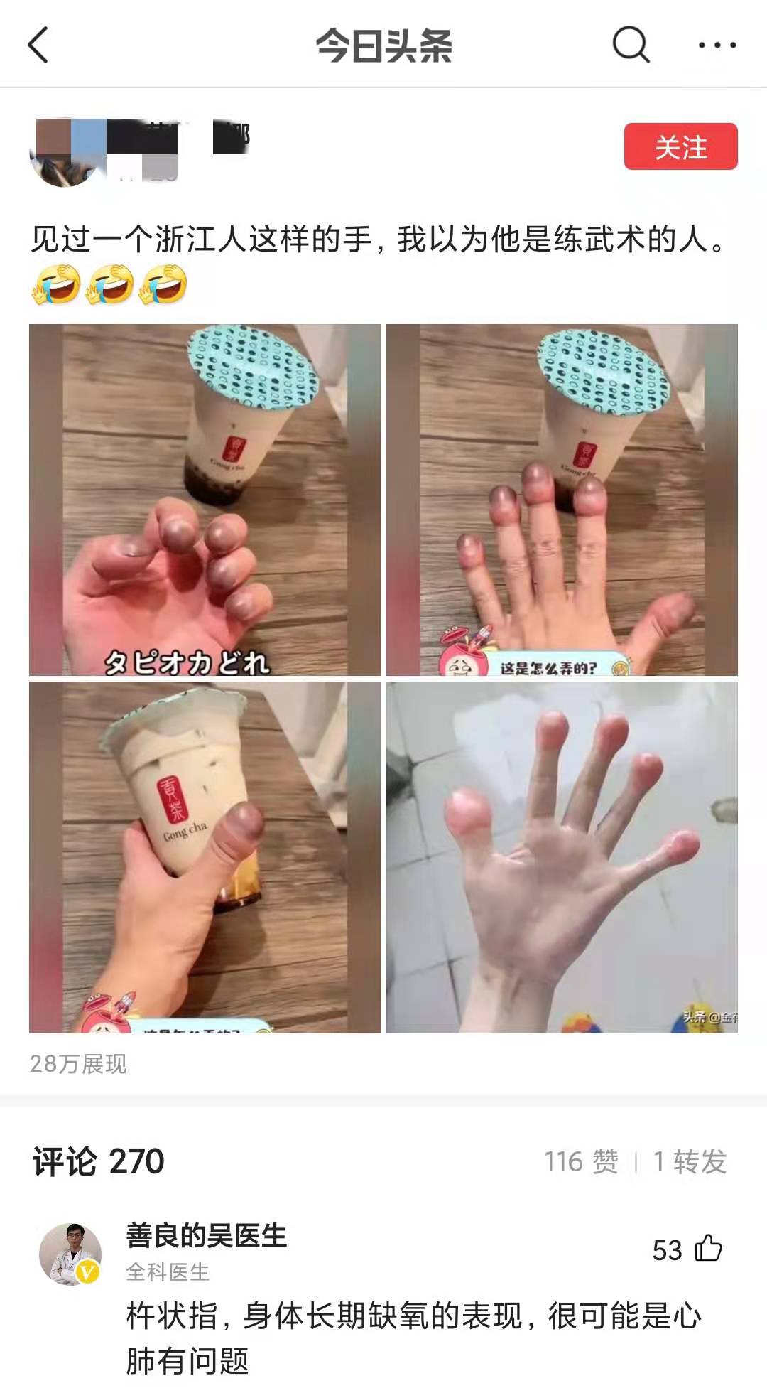 身体有病手指先知？提醒：警惕手指出现的7种变化，或是疾病来袭