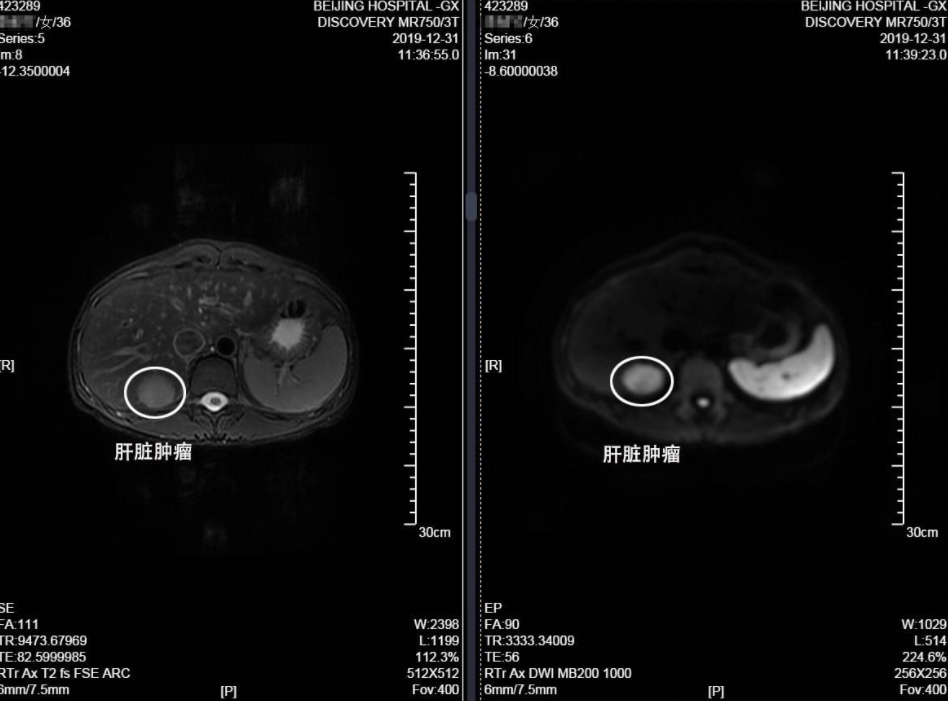 2年没复查，息肉变成癌！B超报告里出现“这些字眼”可能有危险