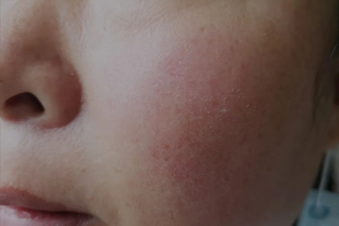 一个人脸上有几种皮肤病？