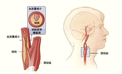 颈动脉斑块，怎么查？怎么治？别吃哪种水果？本文为您全讲清