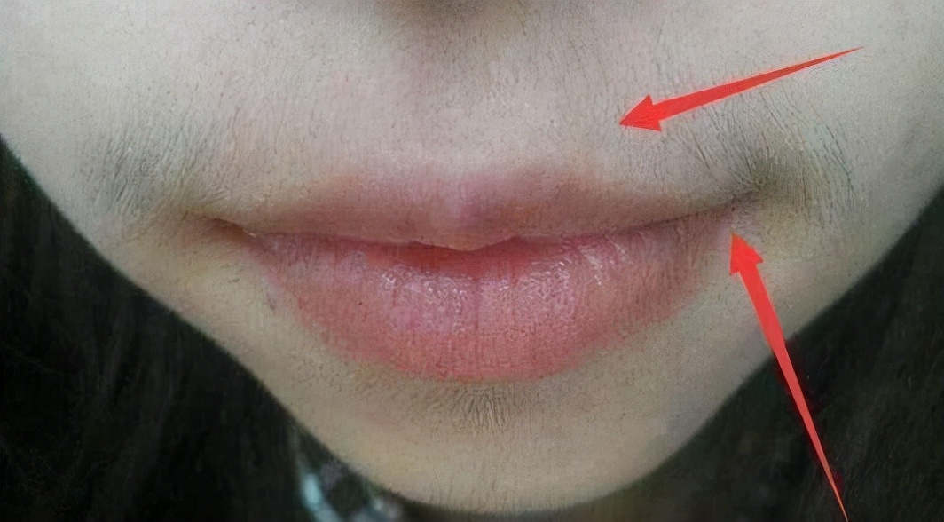 为何有的女性长“小胡子”？别着急刮，可能和这些“病因”有关