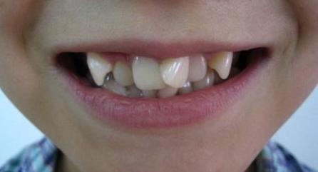 儿童牙齿矫正一般多少钱，孩子牙齿的矫正有3个黄金期？