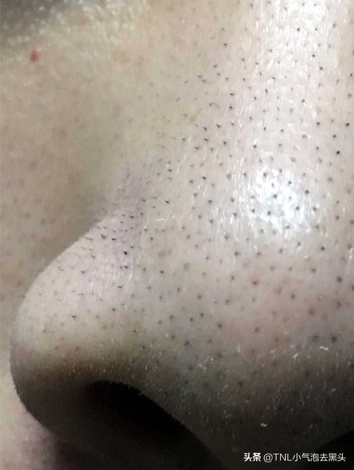 这个鼻子是短粗的黑毛,不是黑头,所以不适合小气泡如果你们不会分辨