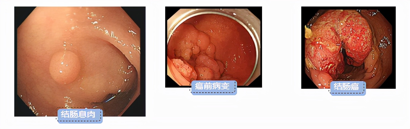 「健康小常识」胃肠道检查 不能忽视