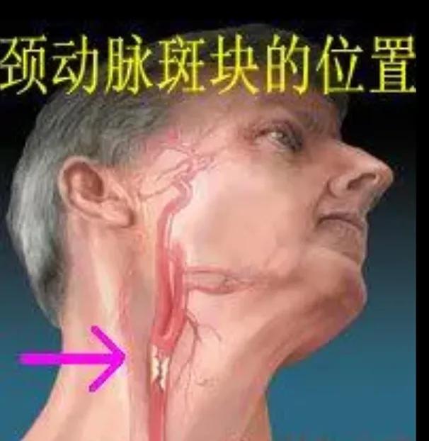 坚持7年，颈动脉斑块“消失”，4种方法“护血管”，真的可以做到