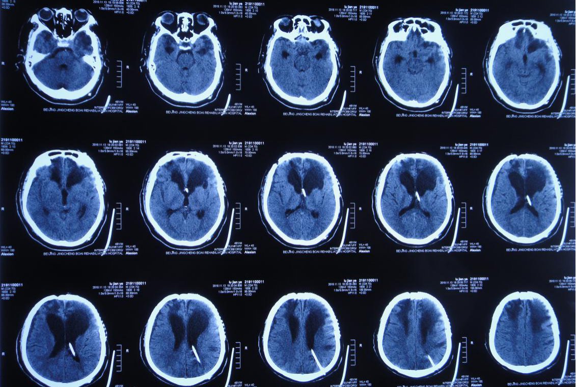 脑外伤颅骨修补术和分流术后脑积水加重致昏迷