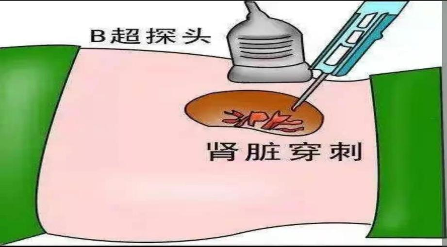 肾穿刺活检术---肾脏疾病诊断金标准