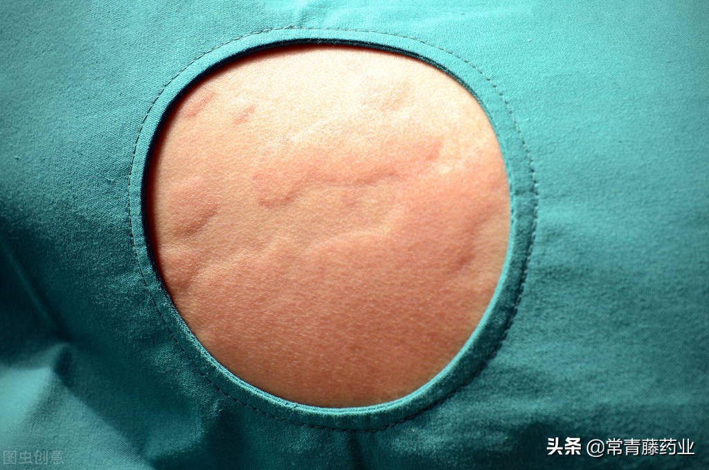 急性荨麻疹图片(荨麻疹一定和过敏有关) - 赤虎壹号