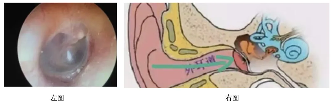 孩子耳朵痛，要警惕什么？不只是中耳炎，这样做孩子少遭罪