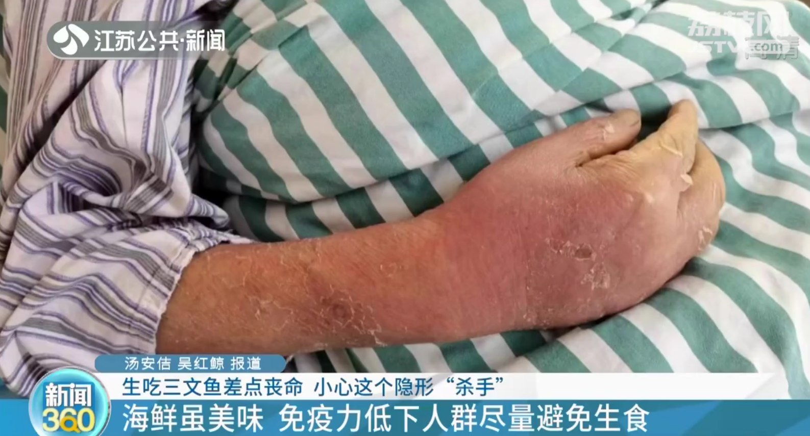 南京：七旬老人生吃三文鱼差点丧命 竟是感染了海洋细菌