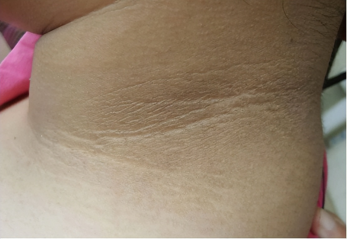 脖子上长出了"小肉粒",别只顾影响美观,也会影响健康