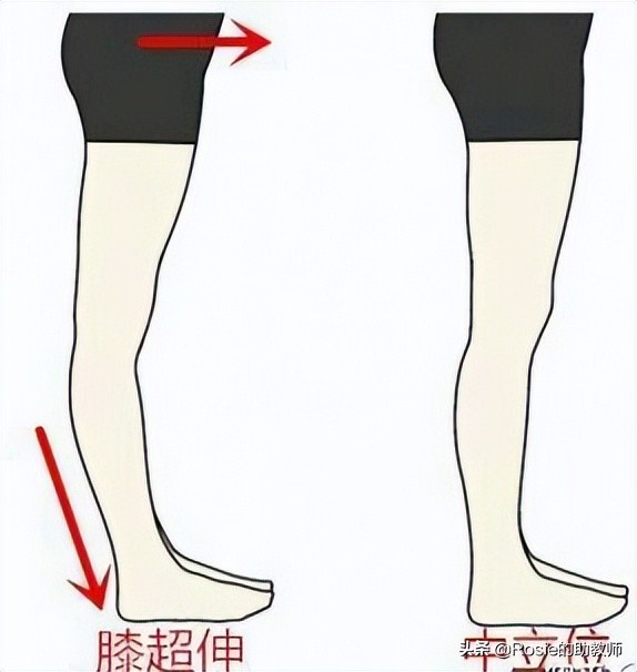 何穗晒照胳膊小腿一样粗，小腿粗壮弯如何瘦？找对成因这样做