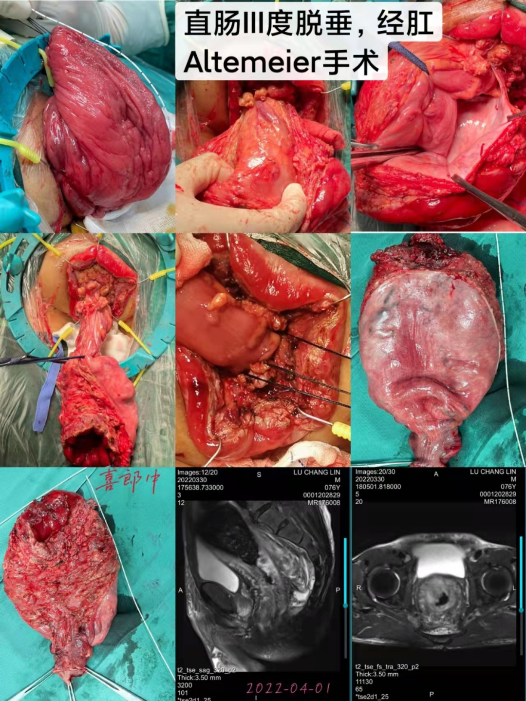 仁医新术丨利用经肛微创外科技术成功治疗多例重度直肠脱垂高龄老年患者