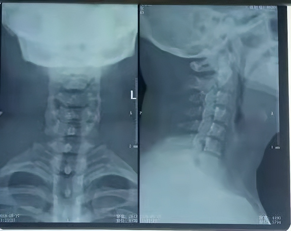 怀疑自己得了颈椎病，到底是做X光片、CT还是核磁？答案都在这