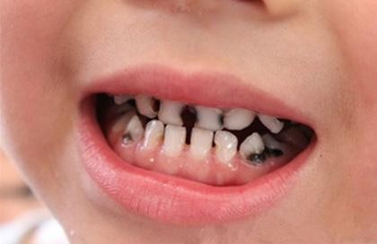 儿童牙齿矫正一般多少钱，孩子牙齿的矫正有3个黄金期？